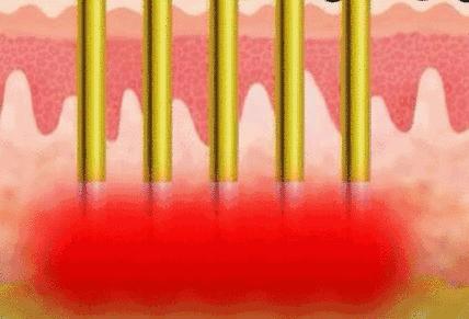 痘坑拯救,痘坑痘印修复祛斑嫩肤科普