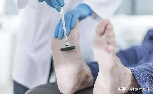 糖尿病足烂脚前有6个症状,糖尿病足早期症状如何治疗