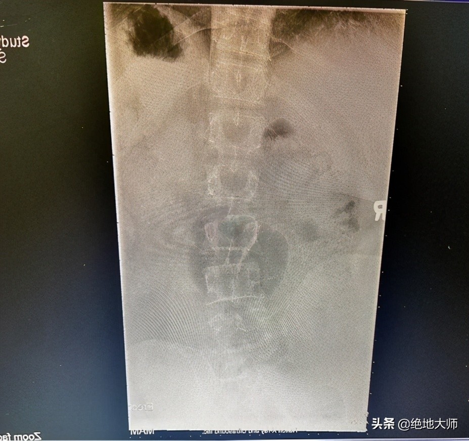 腿长短不一样怎么诊断,腿长短不一怎么调理