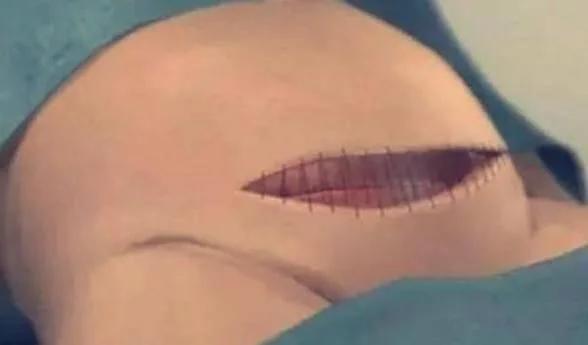 剖腹产仅仅“挨一刀”就完事了?看完四张图,谁说简单和谁急