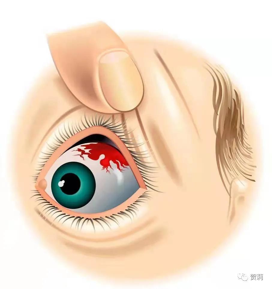 白眼球结膜下出血,结膜下出血是脑溢血前兆吗