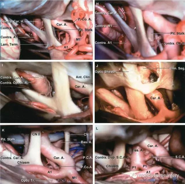 翼点入路技巧图解,翼点入路的开颅要点
