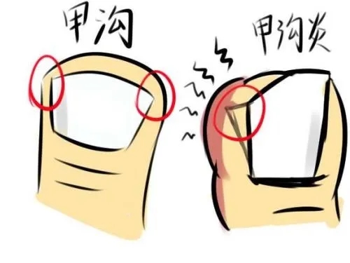 指甲老往肉里长化脓,指甲为什么一直往肉里长