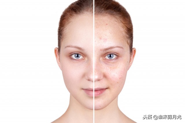 鼻子长痘有痘印快速消除方法,鼻子长痘快速消除方法儿童