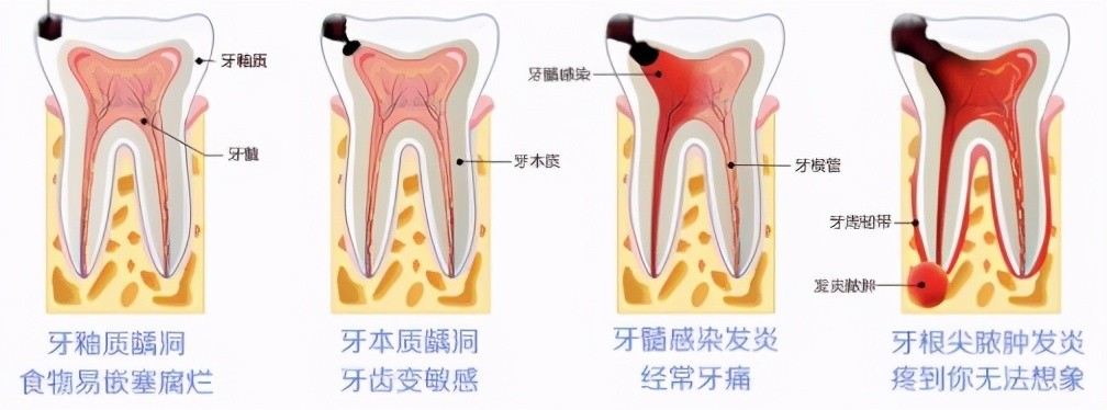 一般看个牙痛多少钱,看个牙包要多少钱