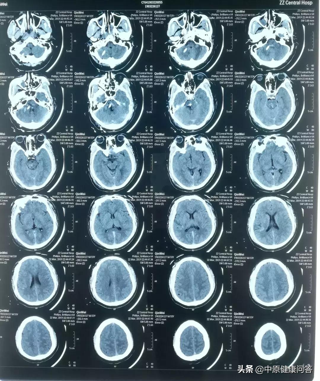 脑干出血发病时的急救常识,40岁突然得脑干出血昏迷有点知觉