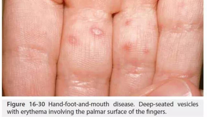 宝宝指甲有白斑倒刺缺什么元素,孩子指甲出白点是缺钙吗