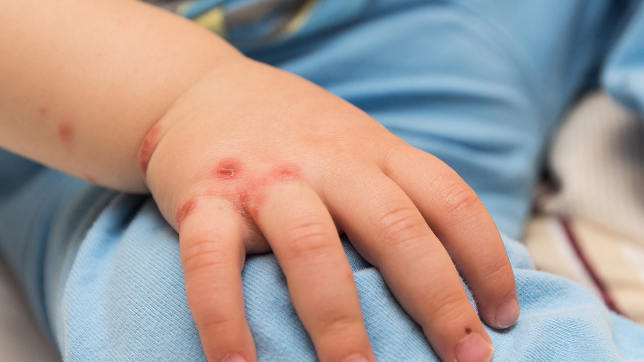 带状疱疹后遗神经痛严重影响患者的日常活动，中医治疗效果较显著