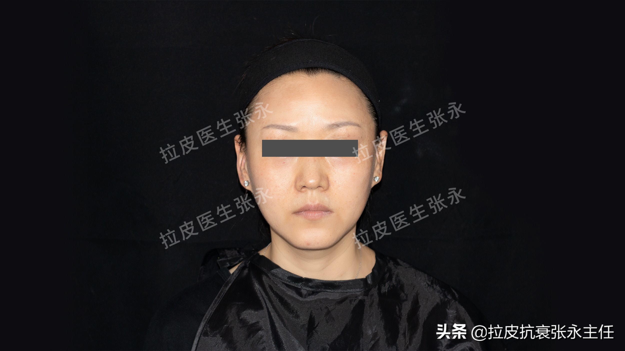 内窥镜小切口拉皮线会不会断,内窥镜拉皮和小切口拉皮哪个好