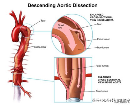 胸主动脉瘤最常见的护理措施,胸主动脉疾病