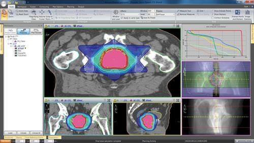 前列腺癌放疗的最佳方法,前列腺癌辅助放疗和挽救放疗