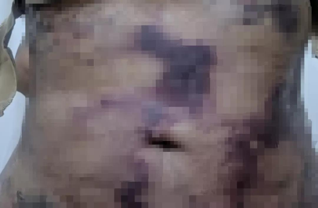 土耳其美女抽脂意外成植物人，卧床4年无起色，幸福生活彻底破碎