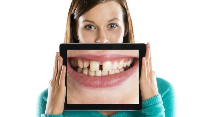 牙缝大怎么办五种方法帮助修复,怎样可以避免牙缝越来越大