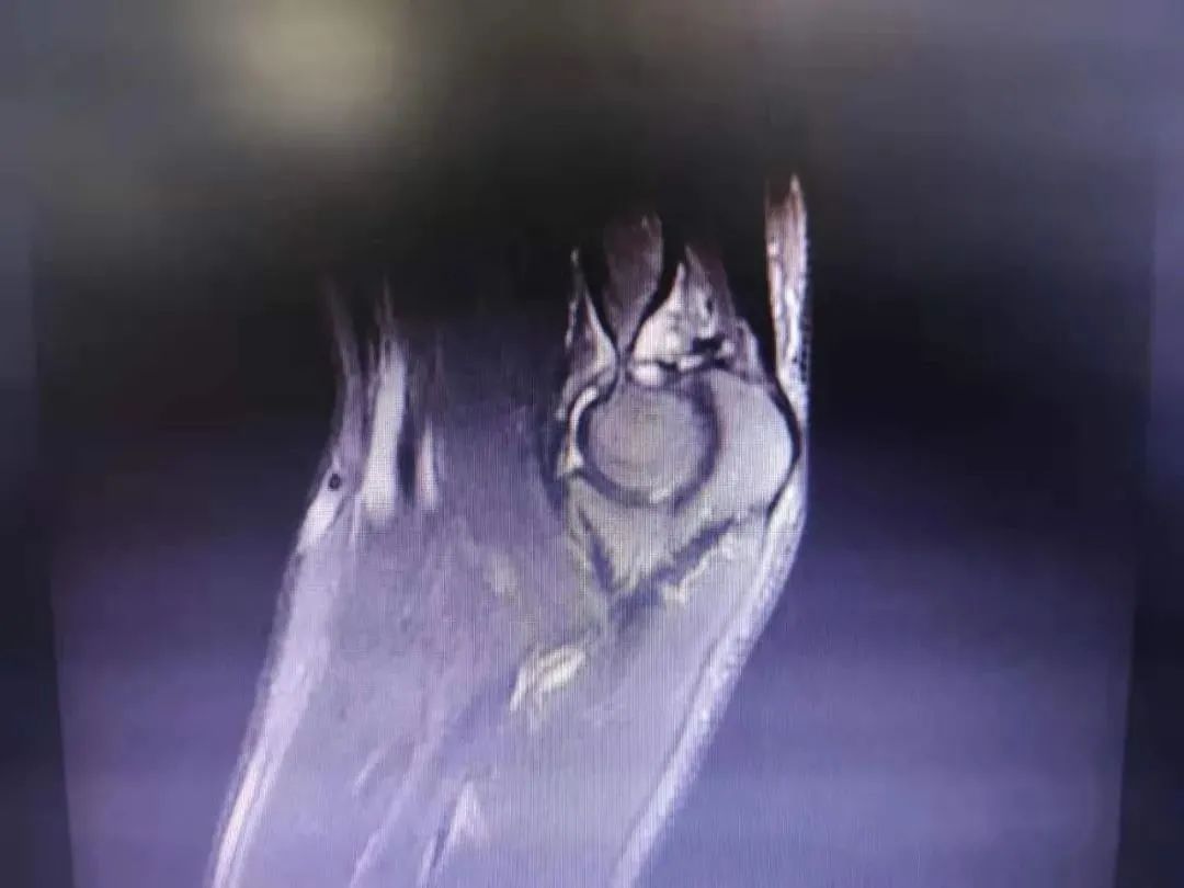 创伤导致肘关节僵硬怎样才能康复,肘关节僵硬康复训练正确方法