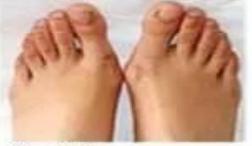 拇外翻陈医生,骨科陈医生治脚后跟疼痛