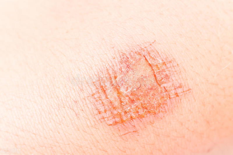 疤痕体质如何调理成不是疤痕体质,疤痕体质和不是疤痕体质区别