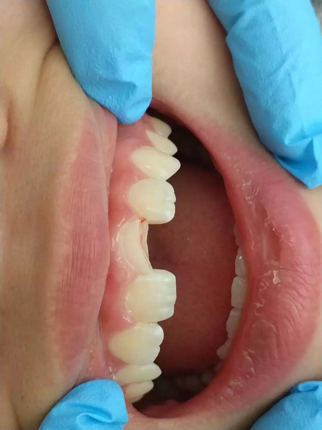 疫情防控期间如何正确预防及应对口腔问题