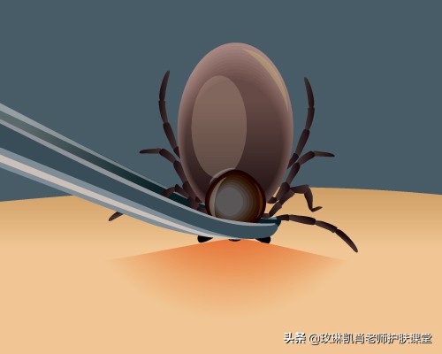 全身被螨虫咬怎么解决,人被螨虫感染了是什么症状