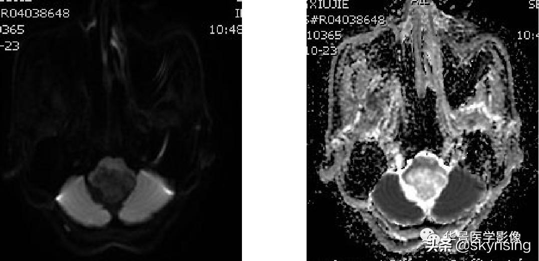 椎体侵袭性血管瘤mri影像学表现,中年妇女脑部血管海绵体瘤的症状