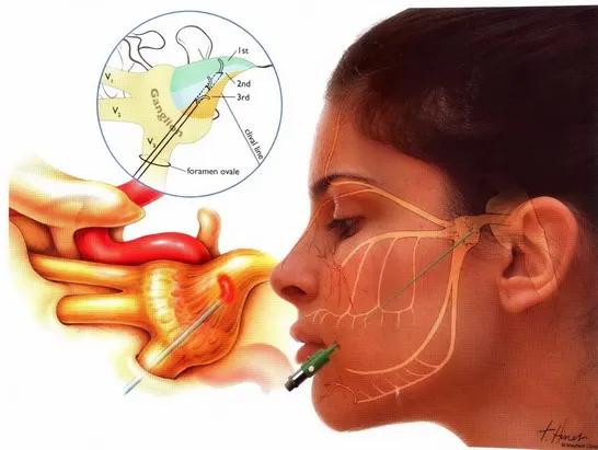 痛痛病疼痛特点,酸痛胀痛或刺痛有什么差别
