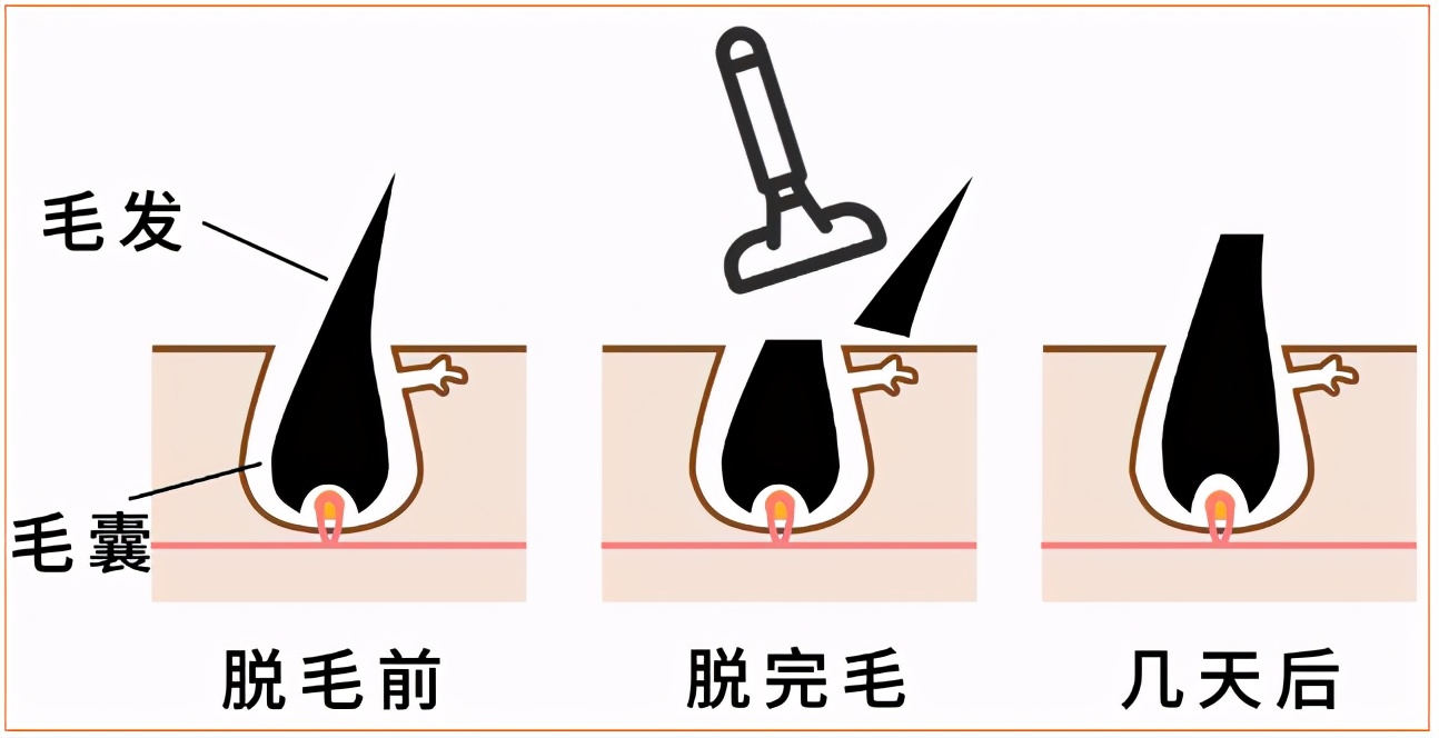 脱毛膏刮胡刀哪个干净,脱毛膏与蜜蜡脱毛哪个更好