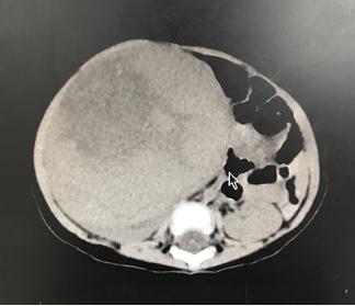4岁小孩得肾母细胞肿瘤,什么样的宝宝容易得肾母细胞瘤