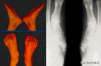 陈旧性踝关节损伤的治疗,踝关节损伤现场处理视频