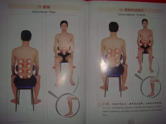 拔罐有哪些穴位图解,最全拔罐穴位疗法图解