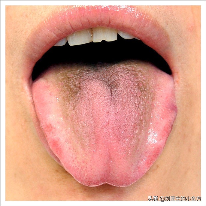 中医舌诊图解100例,中医舌诊图与舌诊口诀