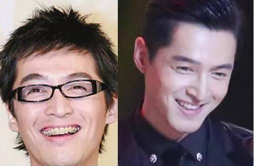 明星整牙前后对比,龅牙明星整牙前后的惊人变化