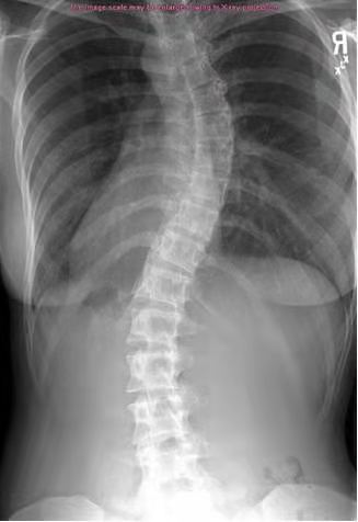 怎么矫正高低肩长短腿,脊柱侧弯高低肩瑜伽体式纠正