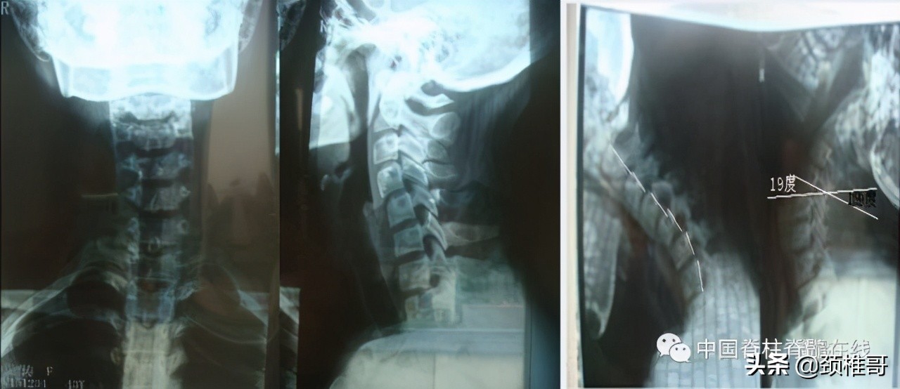 颈椎病的护理临床路径流程图,颈椎病的健康管理与康复指导