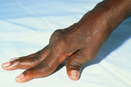 类风湿急性发作期怎么处理,类风湿发作时中医怎么治