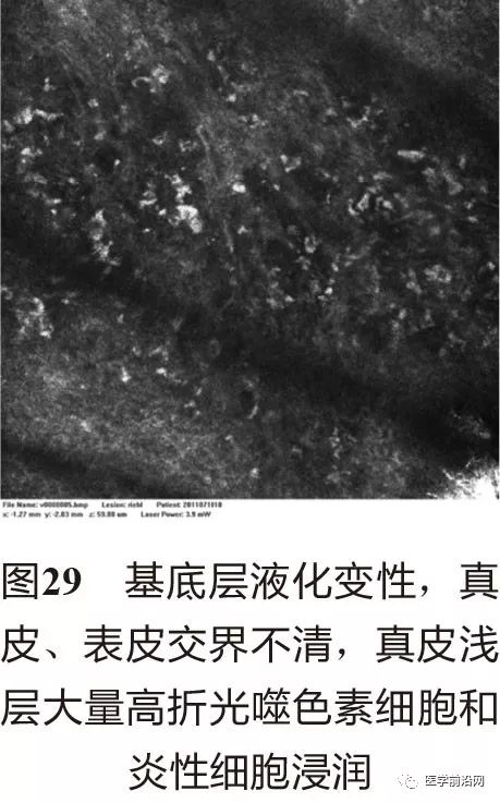 皮肤共聚焦显微镜能查什么,皮肤镜和共聚焦显微镜