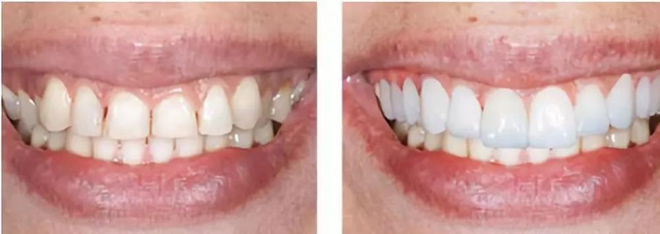 瓷贴面美牙优缺点,什么是全瓷贴面美牙