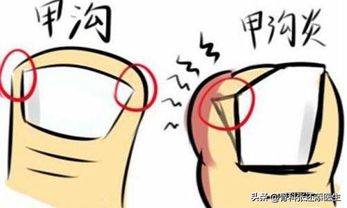 岳云鹏修脚,岳云鹏甲沟炎