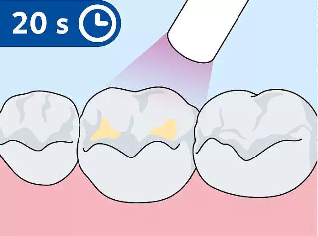 什么是儿童窝沟封闭？会不会痛？1分钟视频带你看懂#雅悦齿科#