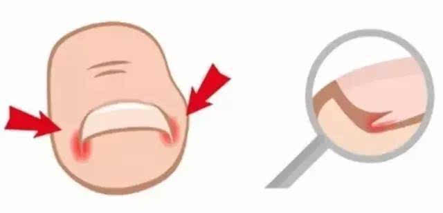 指甲往肉里长怎么办一碰就疼,怎么治甲沟炎的指甲不再长肉里