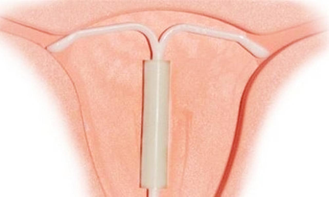 女人绝经后,要不要避孕?节育环没取出有什么后果?医生是这么说的