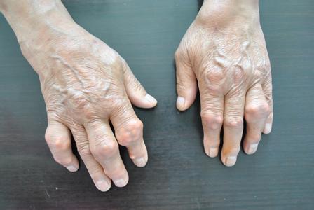 类风湿患者身上起一片疙瘩,类风湿关节有小疙瘩