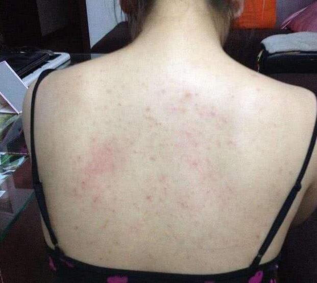 后背痘痘一堆,后背一大片痘痘多年没好