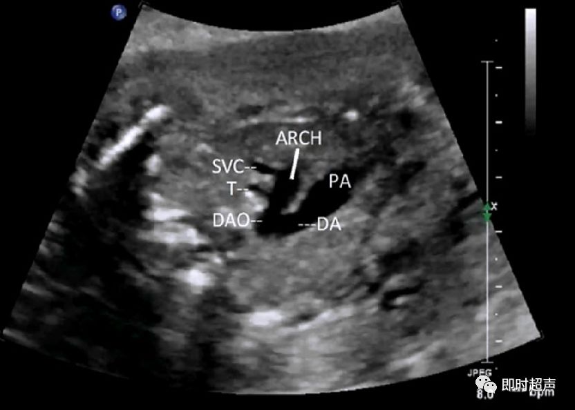 胎儿心脏三种血管关系模式图,25周的胎儿心脏弓切面多少正常