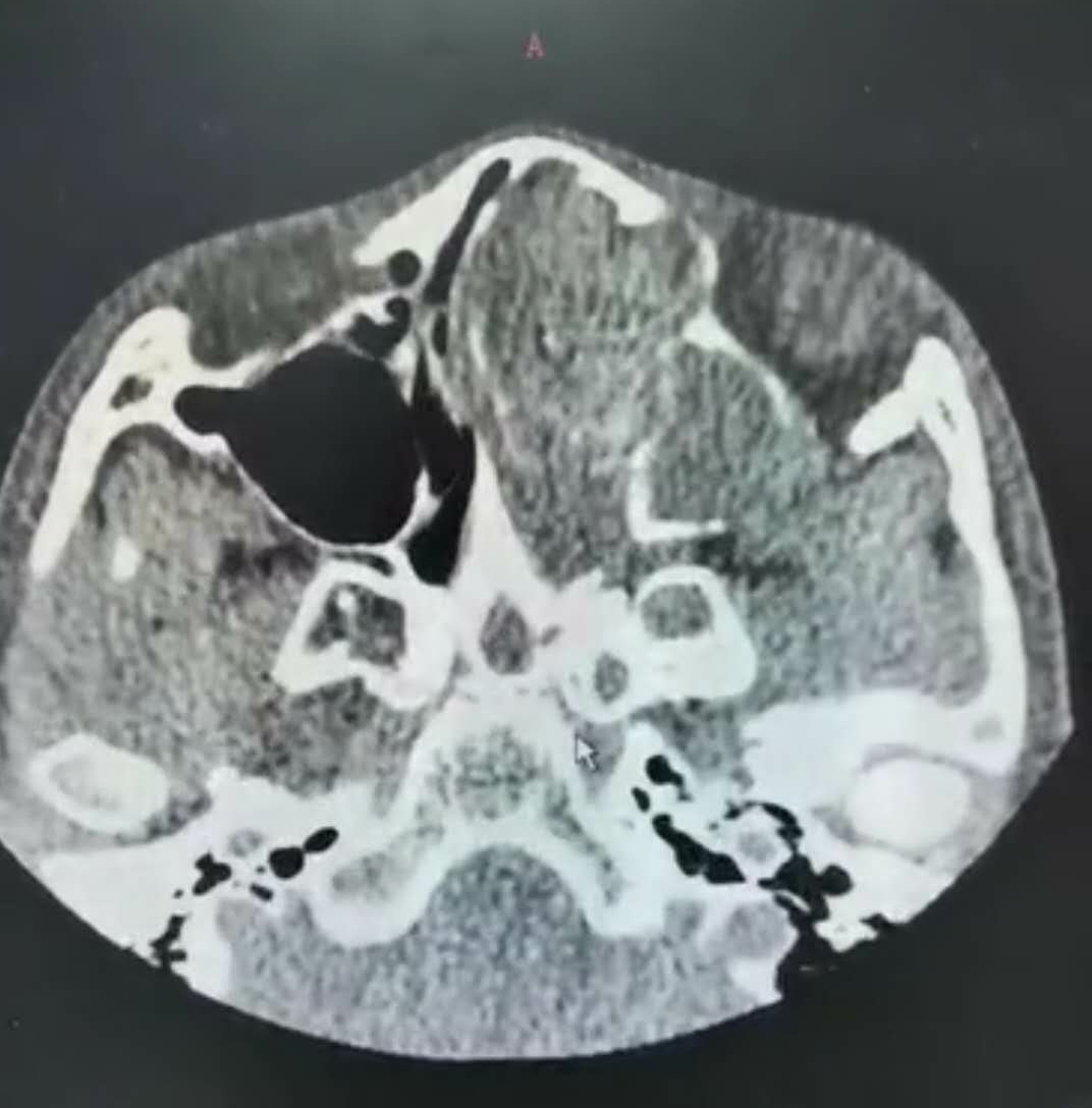 孩子脸部长歪了,孩子脸歪可以矫正吗