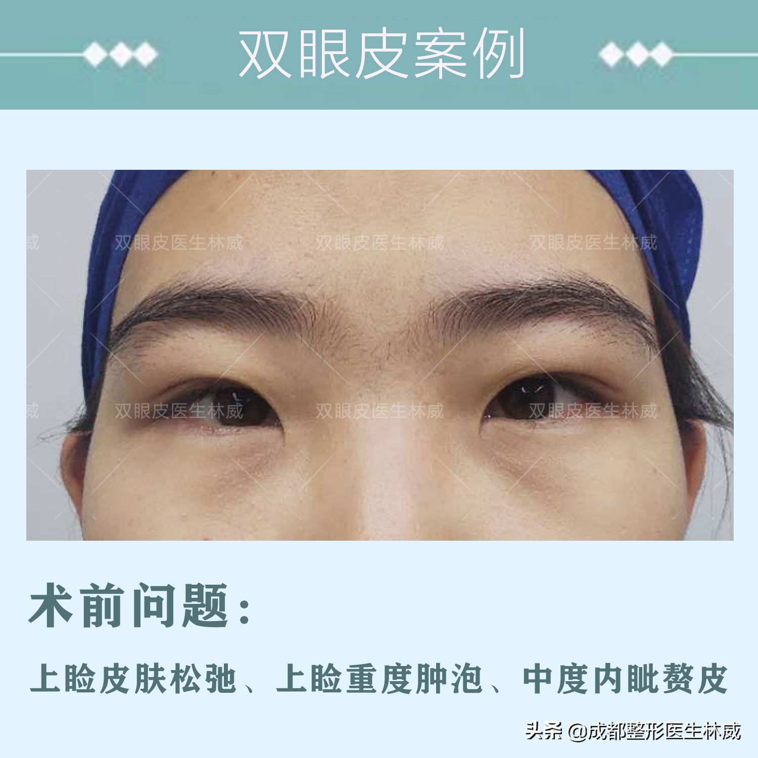 成都林威双眼皮多少钱,成都双眼皮林威医生
