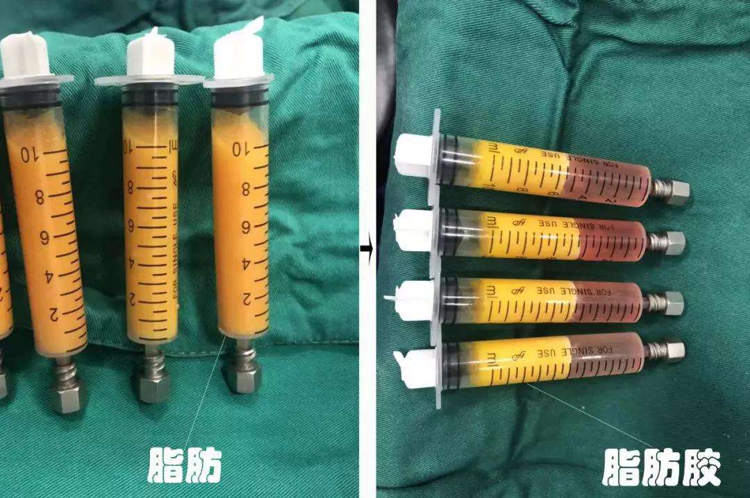 脂肪胶填充好还是自体填充好,纳米脂肪胶和自体脂肪的区别