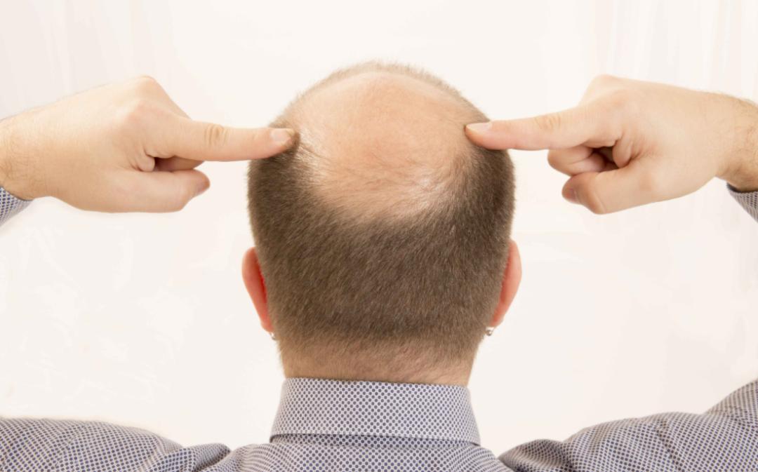 “秃如其来”的90后，造就了一个蒸蒸日上的产业