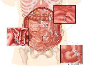 肠梗阻x线鉴别诊断,肠梗阻病人护理诊断