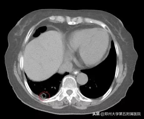 癌症脑转移伽玛刀后遗症,癌症病人接受伽玛刀治疗