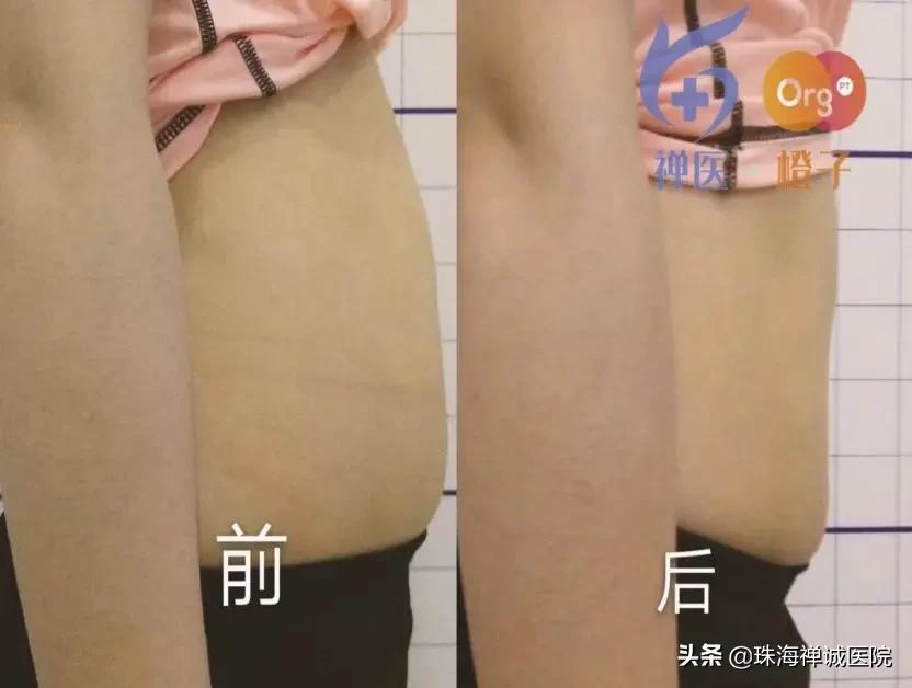 是否要做产后治疗,要不要做产后修复