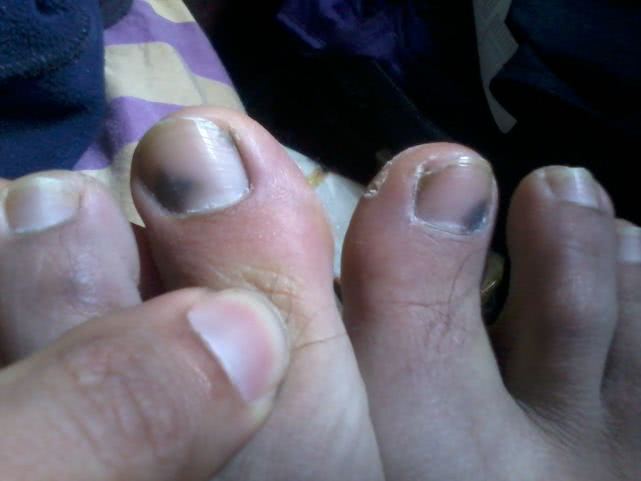 跑步趾甲瘀血原因,为什么跑步会黑脚趾甲